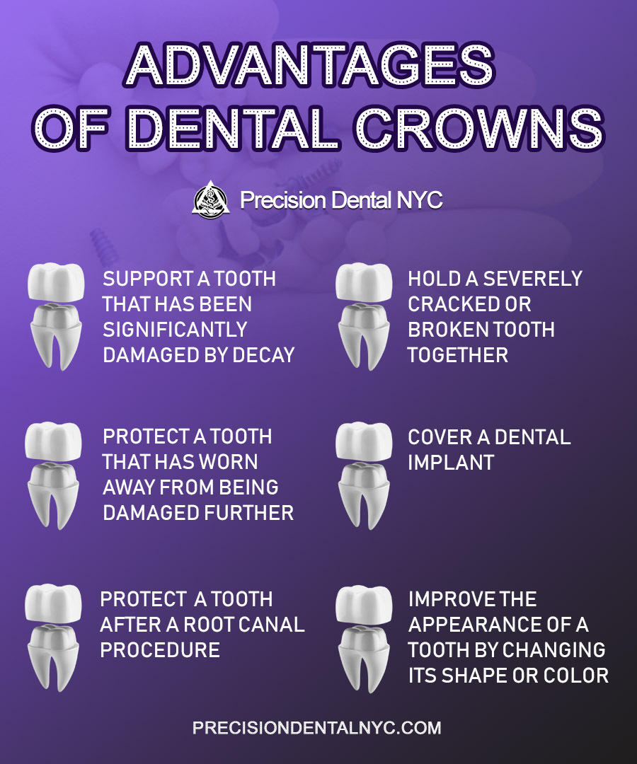 Advantages of Dental Crowns