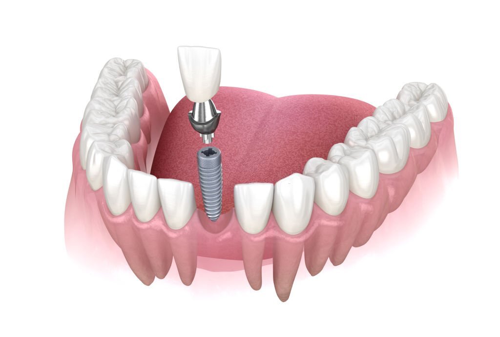 Kien Thuc Implant