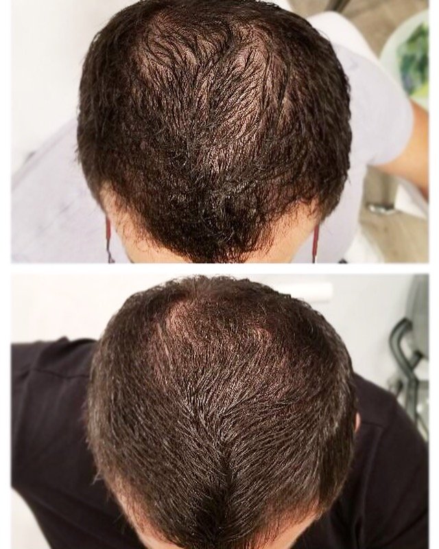 PRP for Hair Loss Los Angeles